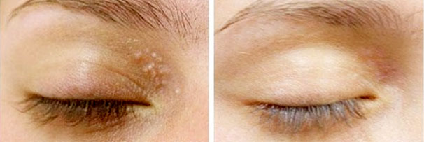 Acne Treatment & Milia Removal