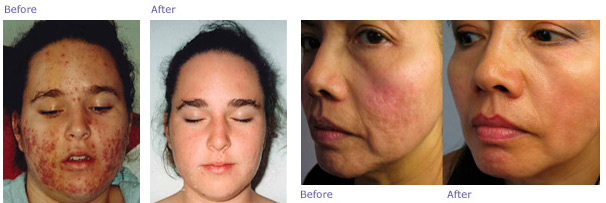 Peels & Microneedling