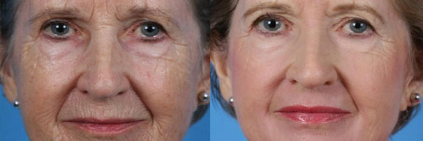 Peels & Microneedling